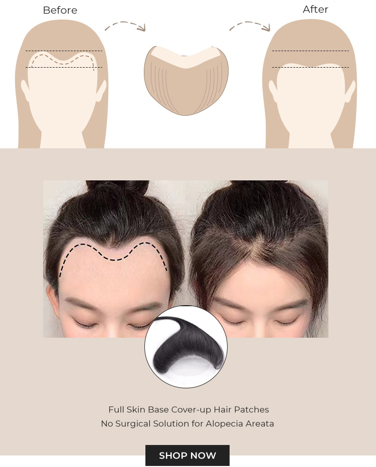 2”X 2” Full Skin Base Human Hair Cover-Up Hair Patches- No Surgical Solution For Alopecia Areata |12”